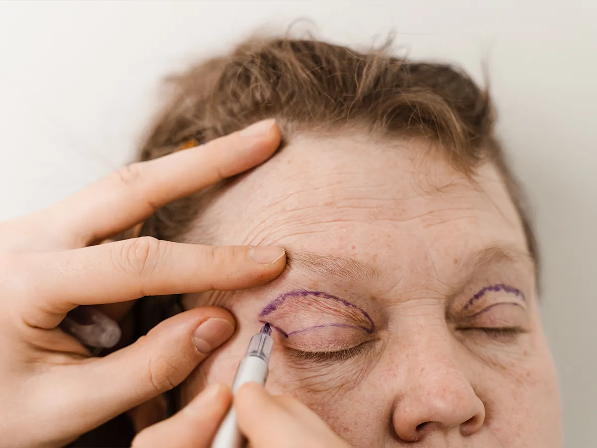 Blefaroplasti (Göz Kapağı Estetiği) - Görsel