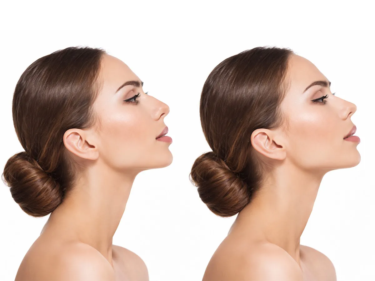 Burun estetiği (Rinoplasti) - Görsel 2