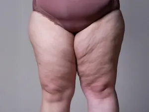 Lipödem (Lipedema, Ağrılı Yağlanma Sendromu)