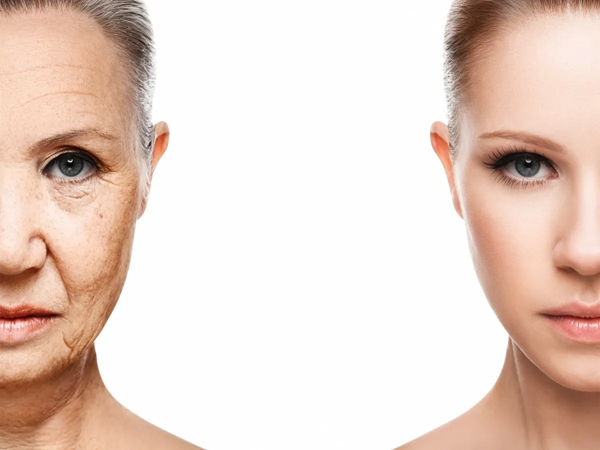 Yüz Germe (Face Lift) - Görsel 2