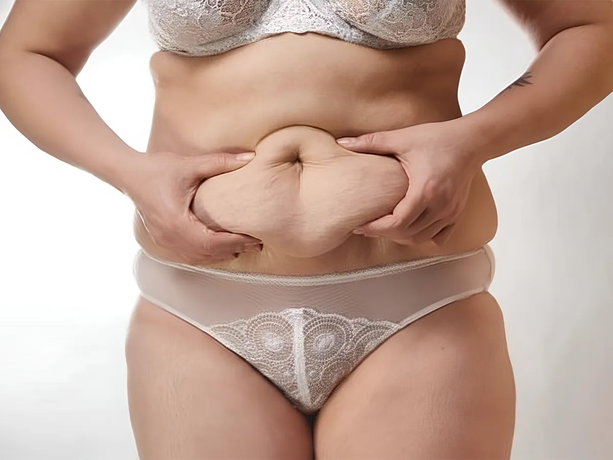 Abdominoplasti (Karın Germe) - Görsel 2