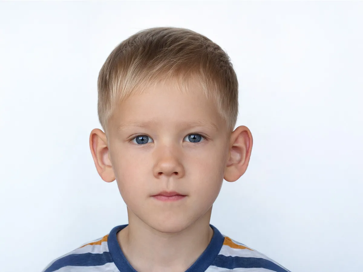 Kepçe Kulak (Kulak Estetiği - Otoplasti) - Görsel 1