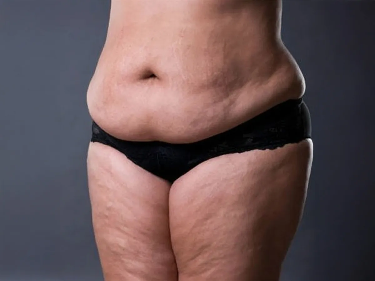 Lipödem (Lipedema, Ağrılı Yağlanma Sendromu) - Görsel