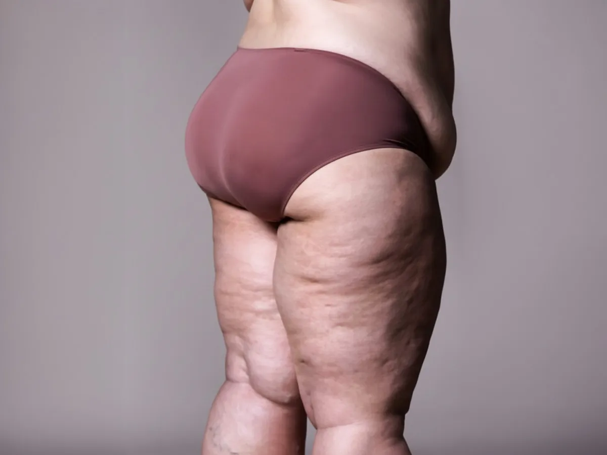 Lipödem (Lipedema, Ağrılı Yağlanma Sendromu) - Görsel 2