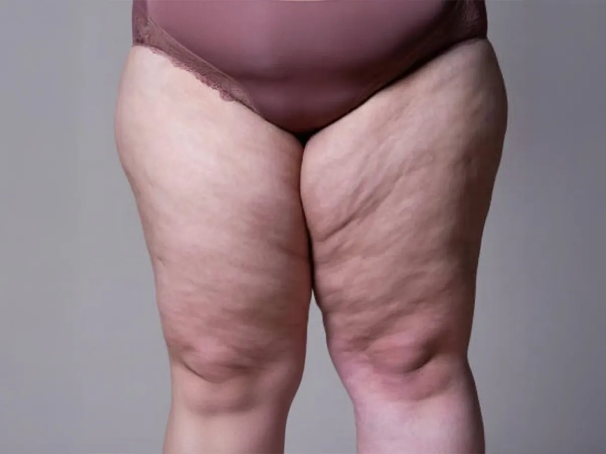 Lipödem (Lipedema, Ağrılı Yağlanma Sendromu)